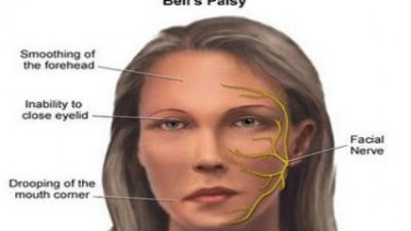 Bells Palsy