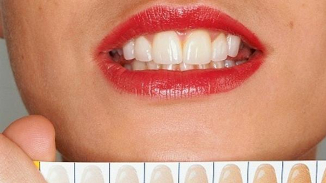 memutihkan atau bleaching gigi