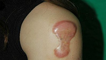Keloid pada lengan atas. 