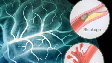 Ilustrasi stroke
