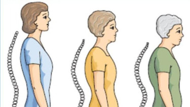 osteoporosis