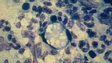 Naegleria fowleri atau amuba pemakan otak dilihat melalui mikroskop