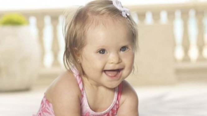 Anak down syndrome