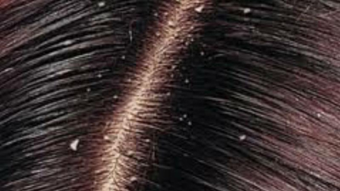 Cara alami mengatasi masalah rambut berketombe