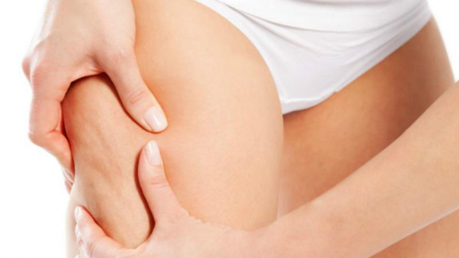 Cara menghilangkan stretch mark