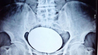Hasil X-Ray Batu Ginjal