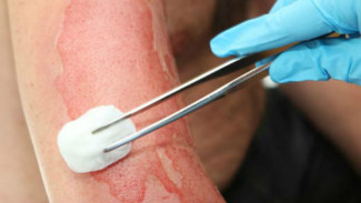 Ini Dia Obat Tradisional Sembuhkan Luka Bakar