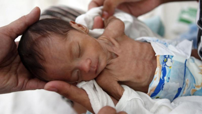 Bayi yang mengalami malnutrisi