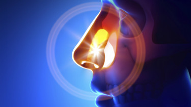 Sinusitis