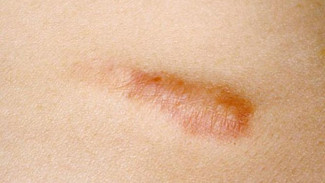 Apa Itu Keloid?