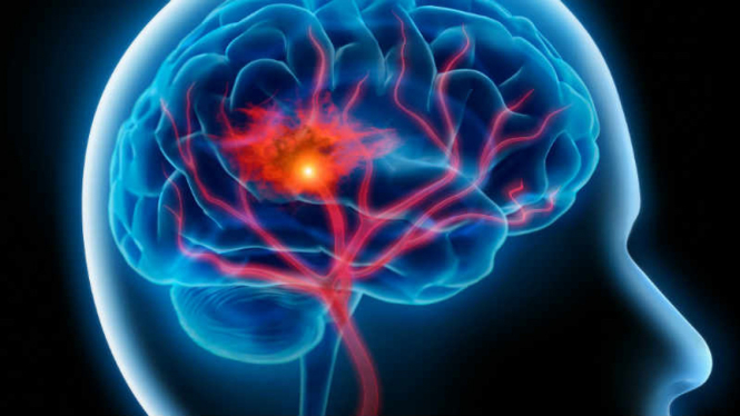 Ilustrasi stroke