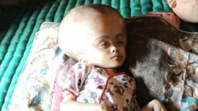 Bocah pengidap hidrosefalus di Jambi