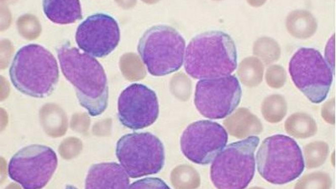 Ilustrasi leukemia.