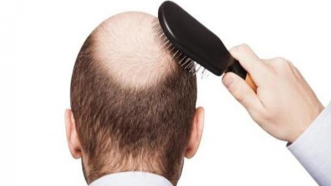 Rambut botak.