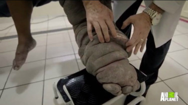Raimundo menderita penyakit kaki gajah karena gigitan nyamuk.