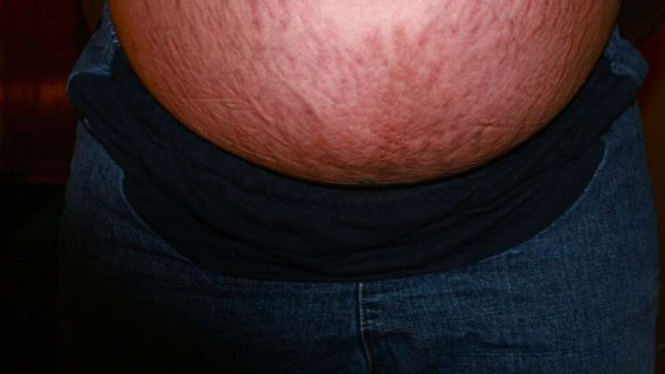 Stretch Marks