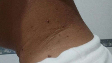 Tahi lalat kecil atau skin tag