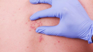 Ilustrasi herpes.