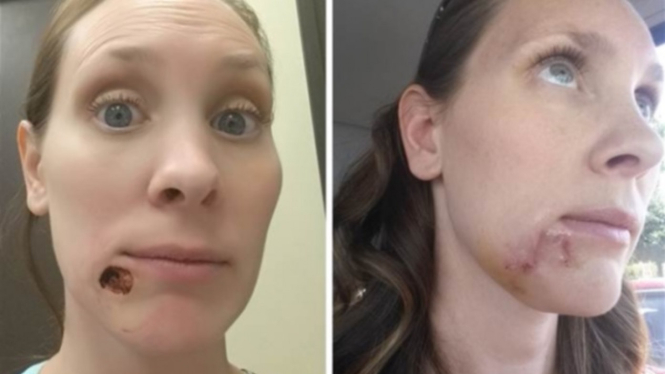 Kari Cummins, wanita penderita kanker karsinoma