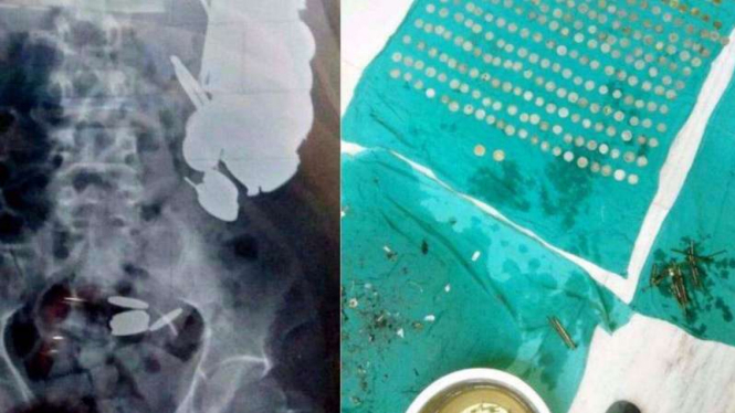 Paku dan koin logam dari dalam tubuh Khan