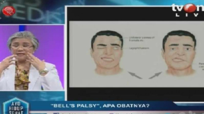 Ayo Hidup Sehat (Bells Palsy)