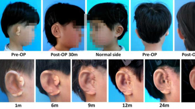 Anak China penyandang mikrotia yang menjalani transplantasi