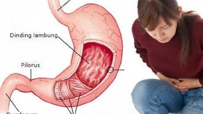 Ilustrasi sakit asam lambung.