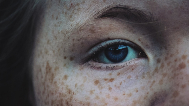 Ilustrasi freckles pada wajah.
