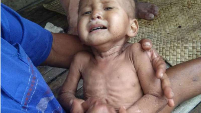 Kondisi mengenaskan anak kurang gizi di Sumba Barat Daya