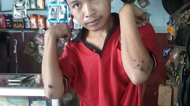 Bahar, warga Depok, perlihatkan luka bekas dianiaya geng motor.