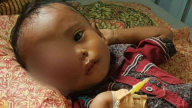 Tilar Negara, bocah 2,2 tahun penderita tumor mata dan busung lapar.