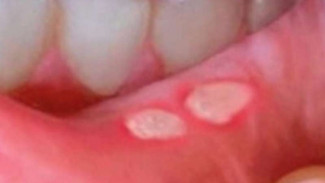 Sariawan Berbulan-bulan Bisa jadi Tanda Kanker dan AIDS