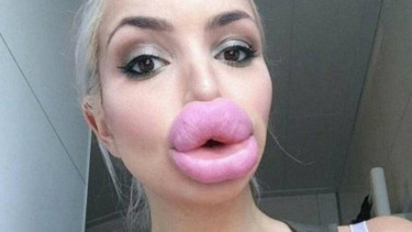 Filler bibir mirip bintang porno