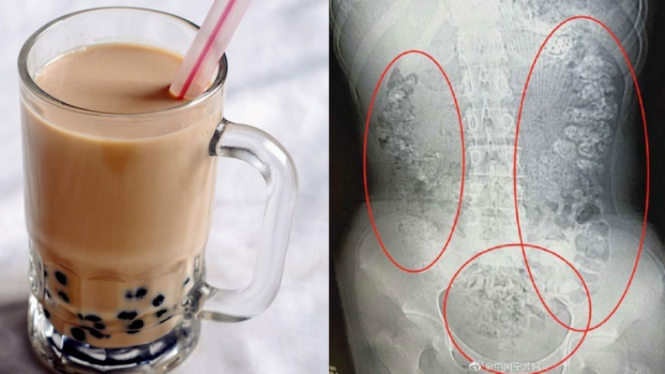 Minum bubble tea berlebihan bisa sebabkan gangguan pencernaan.