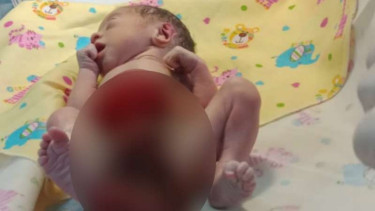 Bayi laki-laki lahir dengan kondisi usus berada di luar perut asal Kabupaten Deli Serdang yang dirujuk ke RSUPH Adam Malik, Medan, Sumatera Utara, Minggu siang, 21 Juli 2019.