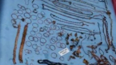Koin dan perhiasan yang ditemukan di perut pasien wanita di India