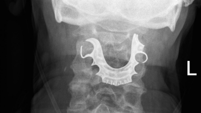 Dokter menemukan gigi palsu di tenggorokan pasien, delapan hari setelah operasi pertama. - BMJ Case Reports 2019