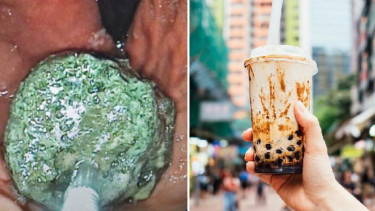 Kena Penyumbatan usus gara-gara minum bubble tea.