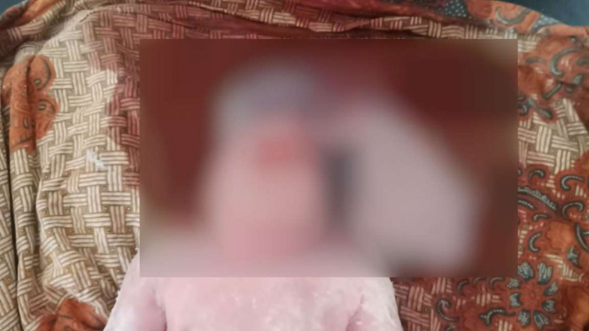 Bayi lahir tanpa batok kepala.