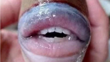 Ikan Bermulut dan Bergigi Manusia