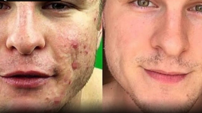Tips hilangkan jerawat dan bintik hitam pada wajah