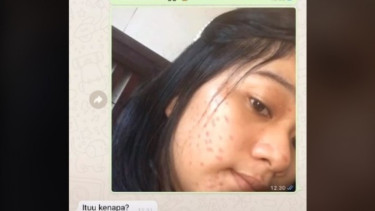 Prank pamer foto jerawatan berujung di blokir