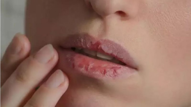 Bibir pecah-pecah