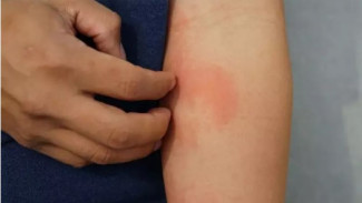 Suami-Istri Punya Riwayat Alergi, Apakah Bisa Menurun ke Anak?