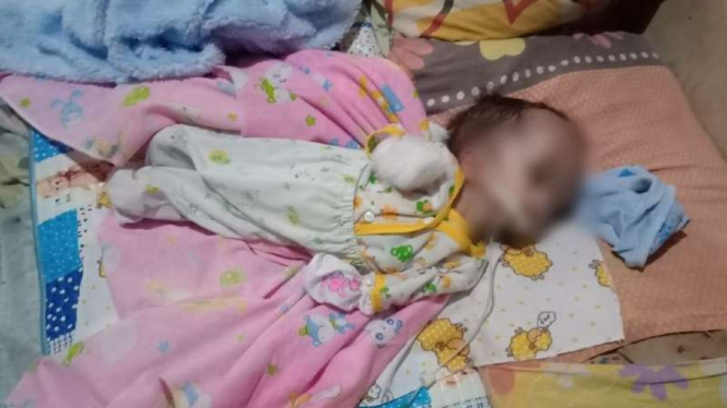 Bayi Fauzan asal Kota Bandung mengalami hidrosefalus