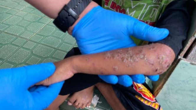 Wabah Scabies serang warga warga Jalan Apel Gang Pisang Berangan, Kalbar