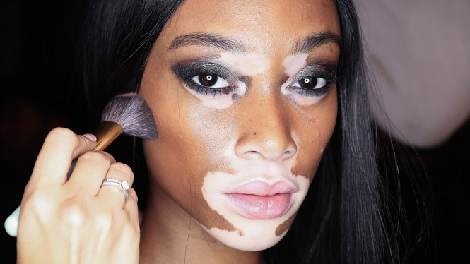 Vitiligo