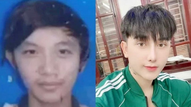 Pria yang Operasi Plastik