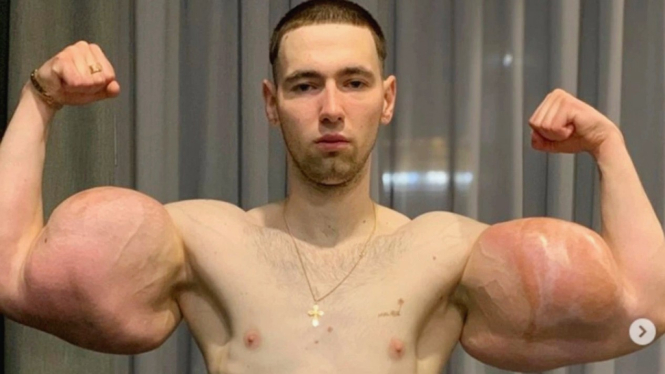 Popeye kw asal Rusia, Kirill Tereshin harus hilangkan daging busuk di lengannya