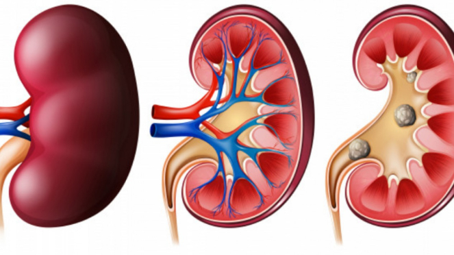 Ilustrasi ginjal/batu ginjal.